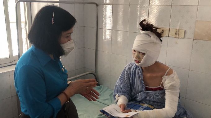 Công nhân Công ty TNHH Seojin Auto bị bỏng nặng: 7 ngày đầu sẽ bị sốt