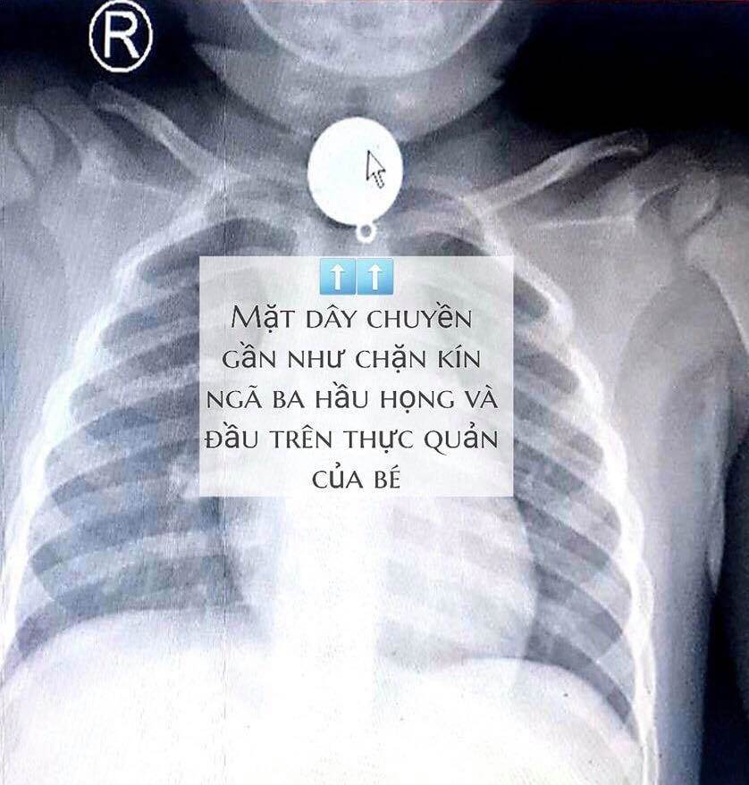 Bé trai 2 tuổi suýt chết vì thói quen đeo dây chuyền cho con của bố mẹ be trai 2 tuoi suyt chet vi thoi quen deo day truyen cho con cua bo me