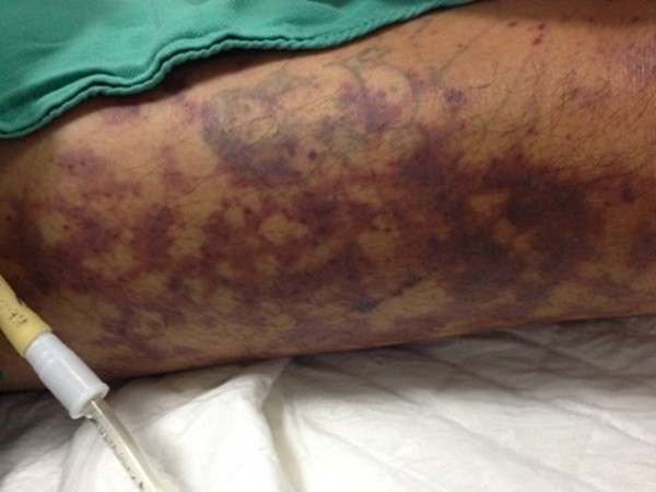 Người bán thịt lợn suýt chết do nhiễm liên cầu khuẩn nguoi ban thit lon suyt chet do nhiem lien cau khuan