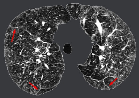 Bệnh phổi kẽ thường tăng nặng trong những ngày giá rét benh phoi ke thuong tang nang trong nhung ngay gia ret