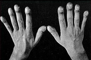 Bệnh phổi kẽ thường tăng nặng trong những ngày giá rét benh phoi ke thuong tang nang trong nhung ngay gia ret