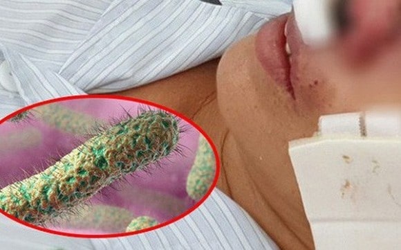 Bệnh Whitmore có phải là “vi khuẩn ăn thịt” người không? benh whitmore co phai la vi khuan an thit nguoi khong