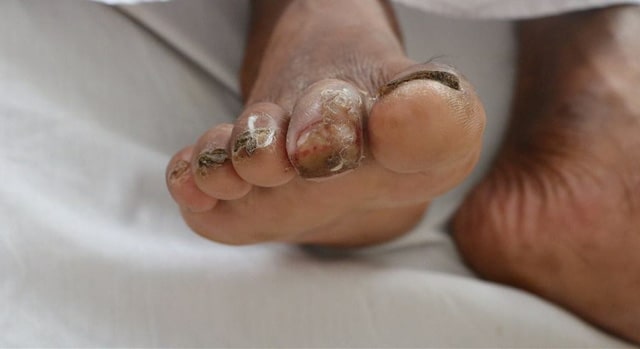 Bệnh Whitmore có phải là “vi khuẩn ăn thịt” người không? benh whitmore co phai la vi khuan an thit nguoi khong