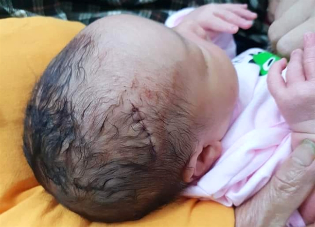 be trai vua lot long da bi khau 6 mui do so suat cua bac sy