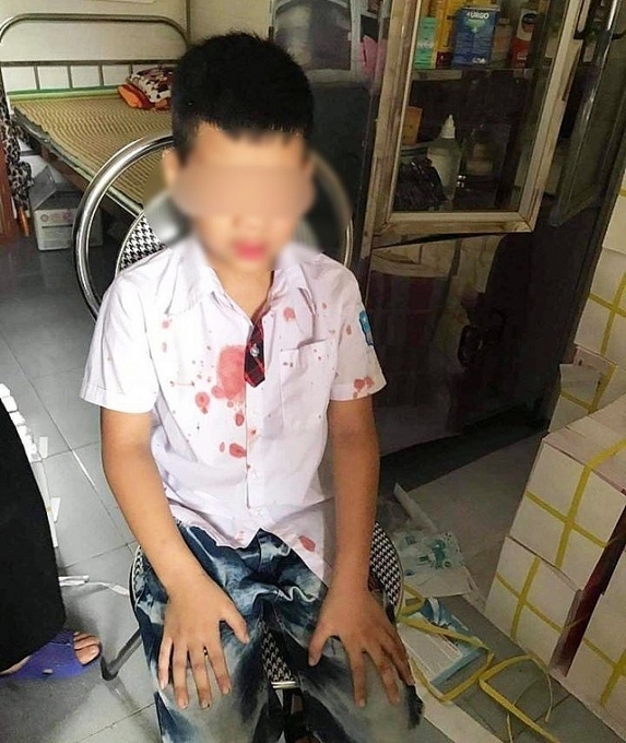 Hòa Bình: Bé trai lớp 1 bị phụ huynh của bạn hành hung gây thương tích, chảy máu hoa binh be trai lop 1 bi phu huynh cua ban hanh hung gay thuong tich chay mau