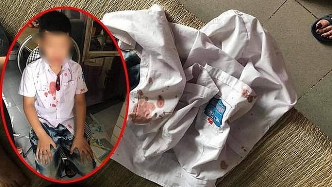 Hòa Bình: Bé trai lớp 1 bị phụ huynh của bạn hành hung gây thương tích, chảy máu hoa binh be trai lop 1 bi phu huynh cua ban hanh hung gay thuong tich chay mau