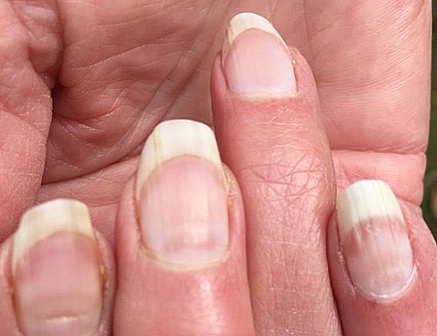 Móng tay có đốm trắng - nguyên nhân và cách điều trị Móng tay có đốm trắng - nguyên nhân và cách điều trị