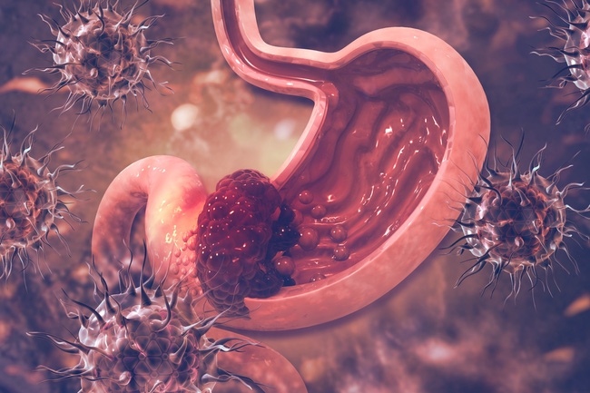 5 loại bệnh ung thư dễ lây giữa vợ và chồng 5 loại bệnh ung thư dễ lây giữa vợ và chồng