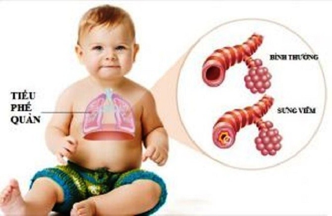 Phòng tránh các bệnh thường gặp thời điểm giao mùa thu đông cho trẻ phong tranh cac benh thuong gap thoi diem giao mua thu dong cho tre