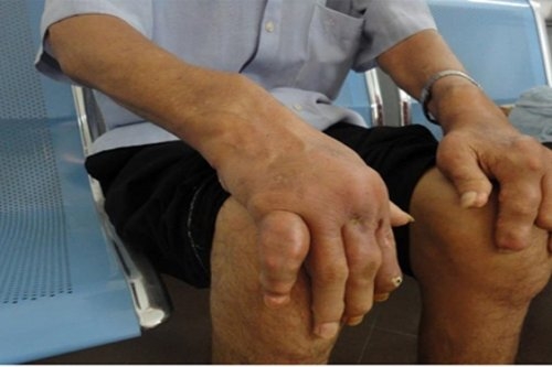 Hãy cảnh giác thuốc gút rởm kẻo tiền mất tật mang hay canh giac thuoc gut rom keo tien mat tat mang