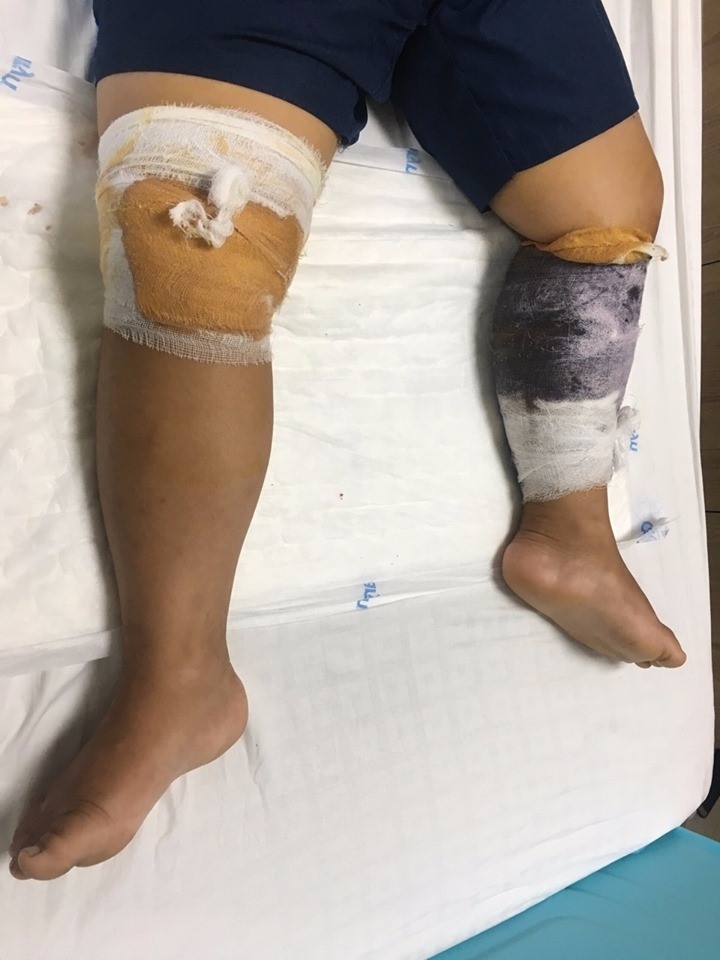 bi cho lai can be trai 7 tuoi phai khau gan 70 mui