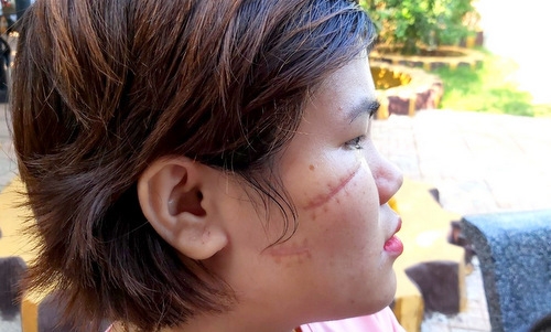 Nữ công nhân bị rạch mặt, khâu 25 mũi trên đường đi làm