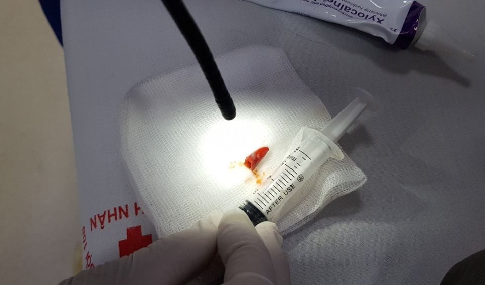 Mắc dị vật trong phế quản người đàn ông bị đóng mủ do thói quen ăn ớt sai cách