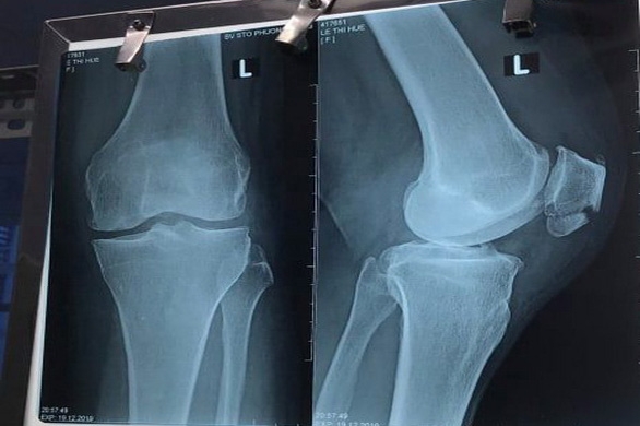 TP.HCM: Nữ bệnh nhân bị gãy xương bánh chè khớp gối, sau khi tiêm đã hôn mê và tử vong tphcm nu benh nhan bi gay xuong banh che khop goi sau khi tiem da hon me va tu vong