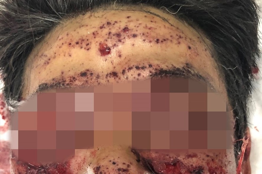 phao no khien nguoi dan ong bi nat het mat be trai phai cat cut ban tay