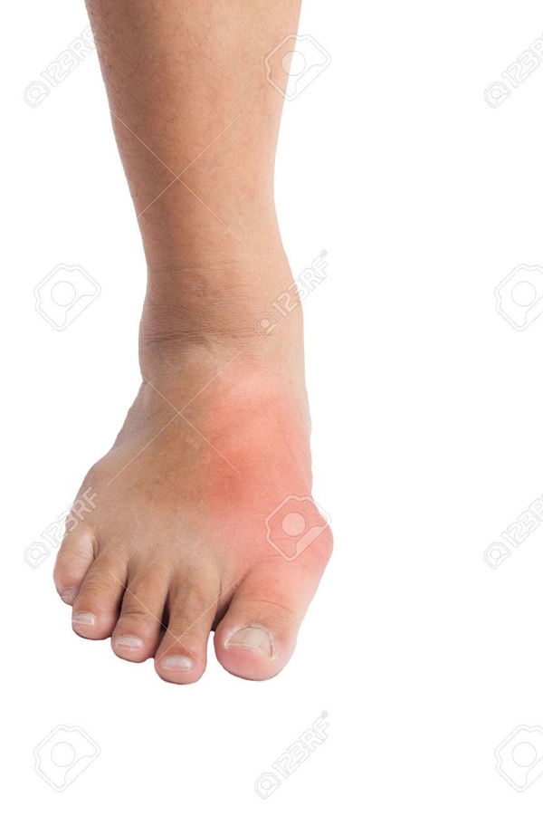 Bệnh gout và chế độ ăn cho người bị bệnh gout benh gout va che do an cho nguoi bi benh gout