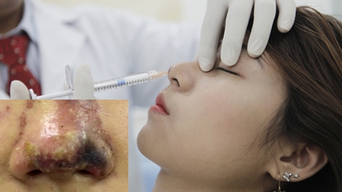 nguy co tiem an tai bien khi cay mo mat tu than tiem chat lam day