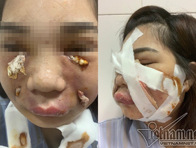 nguy co tiem an tai bien khi cay mo mat tu than tiem chat lam day