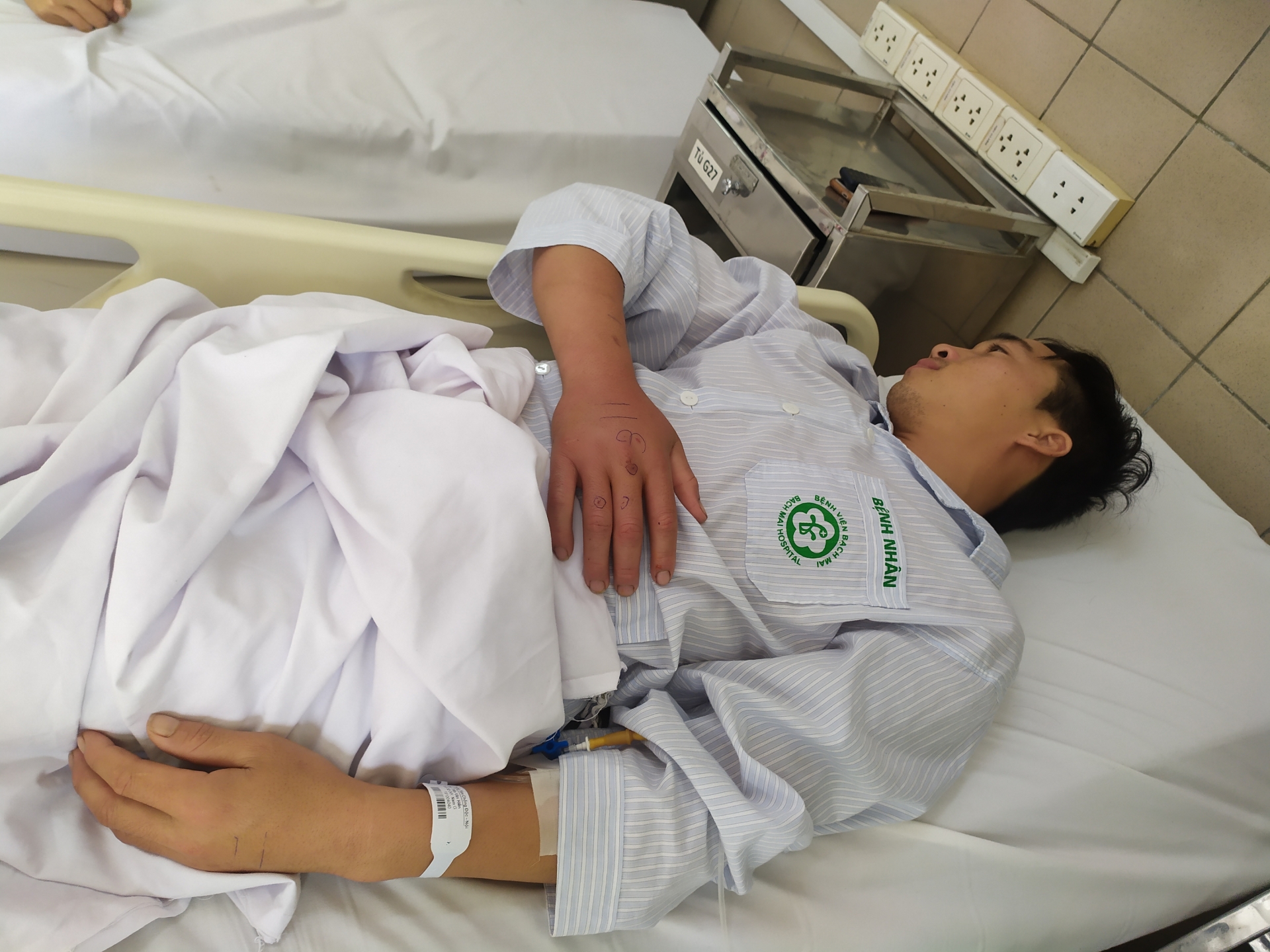 Trung tâm Chống độc Bạch Mai cứu sống một công nhân bị rắn hổ mang bành cắn