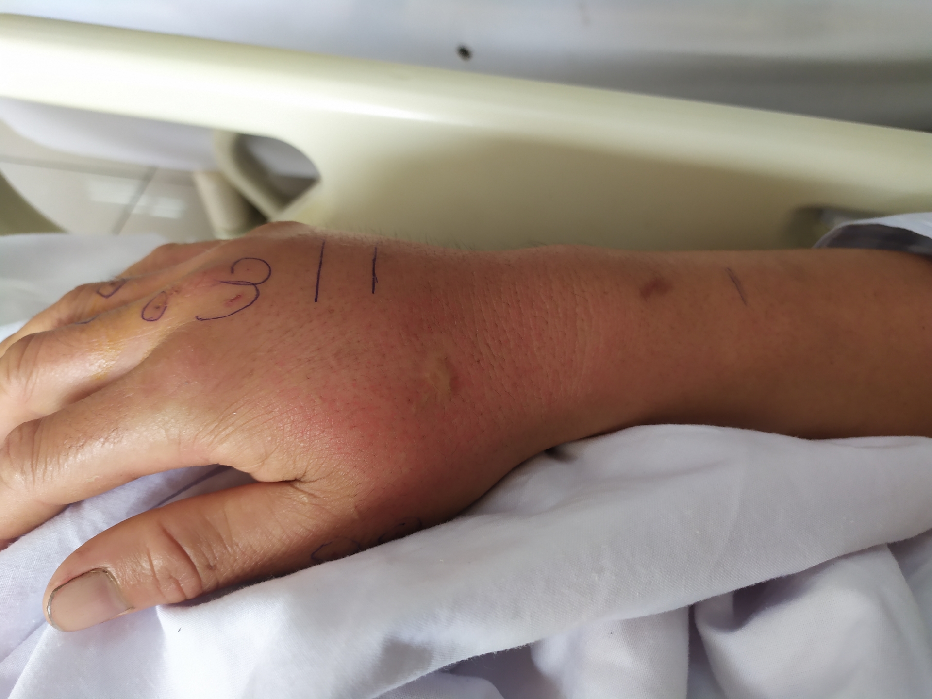 Trung tâm Chống độc Bạch Mai cứu sống một công nhân bị rắn hổ mang bành cắn trung tam chong doc benh vien bach mai cuu song mot cong nhan bi ran ho mang banh can