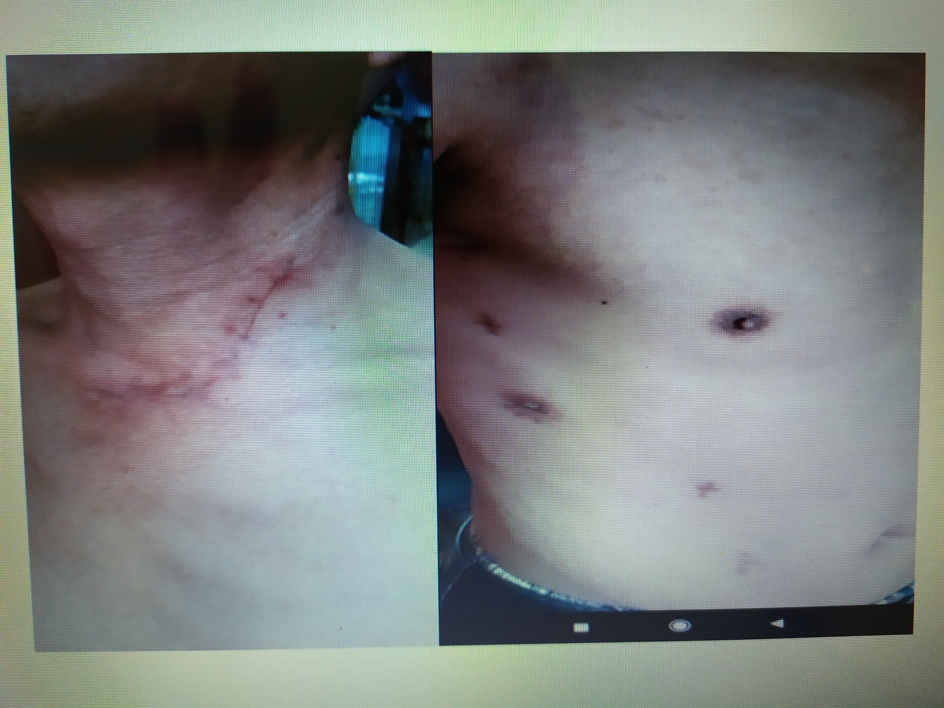 Bước tiến mới điều trị ung thư thực quản: Phẫu thuật nội soi hoàn toàn với ống dạ dày buoc tien moi dieu tri ung thu thuc quan phau thuat noi soi hoan toan voi ong da day