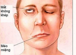 Cẩn thận liệt mặt, méo miệng mùa lạnh