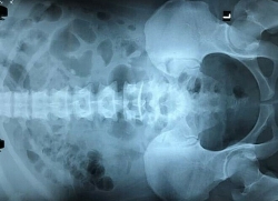 giam beo than toc bang thuc pham chuc nang tien an nguy co suy than