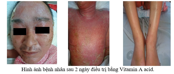 Người đàn ông "đóng vảy" toàn thân sau tiêm corticoid nguoi dan ong dong vay toan than sau tiem corticoid