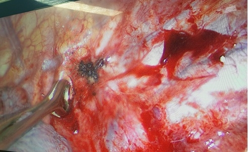 Hút thuốc lá 5 năm, nam thanh niên bị tràn khí màng phổi gây đứt dây chằng đỉnh phổi hut thuoc la 5 nam nam thanh nien bi tran khi mang phoi gay dut day chang dinh phoi