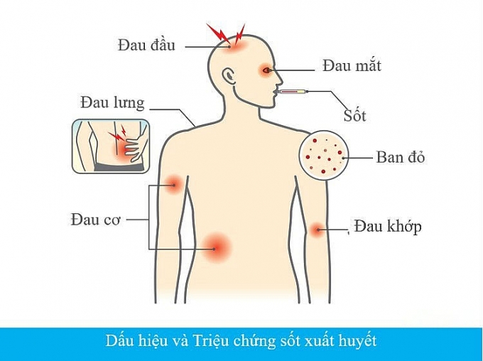 Dấu hiệu nhận biết mắc sốt xuất huyết và cách phòng tránh dau hieu nhan biet mac sot xuat huyet va cach phong tranh