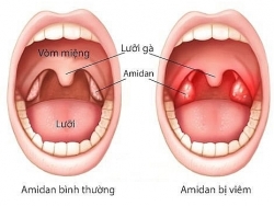 5 mẹo điều trị viêm amidan tại nhà an toàn, không cần cắt