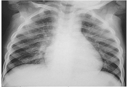 phong tranh cac benh thuong gap thoi diem giao mua thu dong cho tre