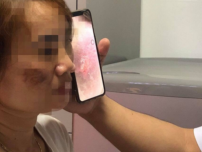 mot phu nu nhiem trung da sau khi tri nam tai spa