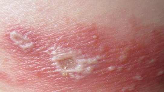 cach xu tri khi dinh doc kien ba khoang