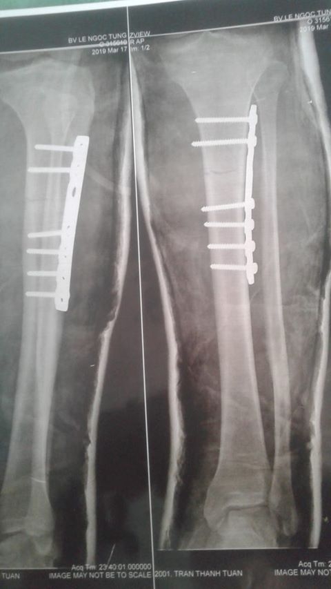 Doanh nghiệp bỏ mặc khi người lao động bị tai nạn lao động doanh nghiep bo mac khi nguoi lao dong bi tai nan lao dong