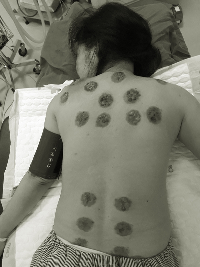 Đi giác hơi cải thiện sức khỏe, người phụ nữ bị hoại tử cả lưng