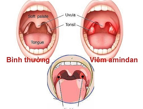 Những dấu hiệu thầm lặng của bệnh sỏi amiđan và những biến chứng bạn chưa biết nhung dau hieu tham lang cua benh soi amidan va nhung bien chung ban chua biet