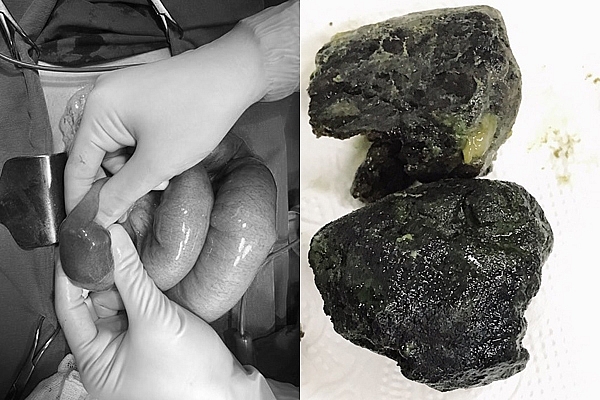 Uống trà sữa thay cơm - thanh niên trẻ nhập viện cấp cứu vì bị tắc đường ruột uong tra sua thay com thanh nien tre bat ngo nhap vien cap cuu vi bi tac duong ruot