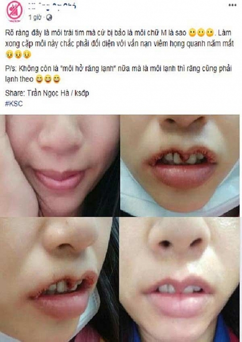 hot trend moi canh en mazda va nhung nguy co ruoc hoa khi phau thuat tham my moi