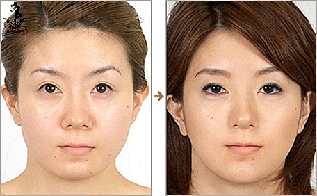 Những xu hướng phẫu thuật thẩm mỹ hot nhất năm 2019 nhung xu huong phau thuat tham my hot nhat nam 2019