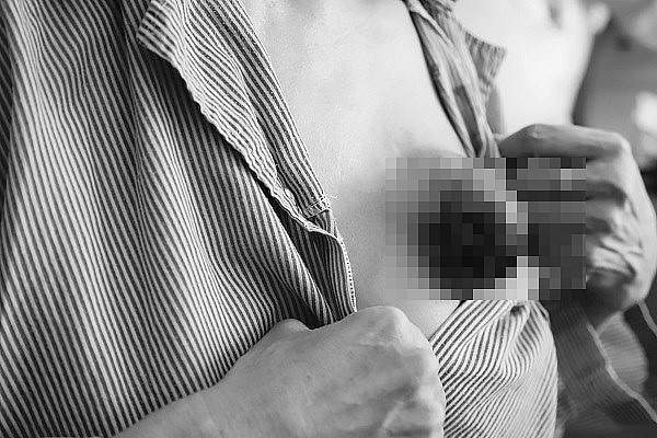 Chữa ung thư vú bằng pháp luân công, người phụ nữ nhận hậu quả nặng nề chua ung thu vu bang phap luan cong nguoi phu nu nhan hau qua nang ne