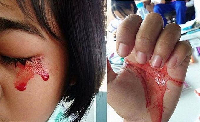 bi coi la phu thuy vi hoi chung khoc ra mau