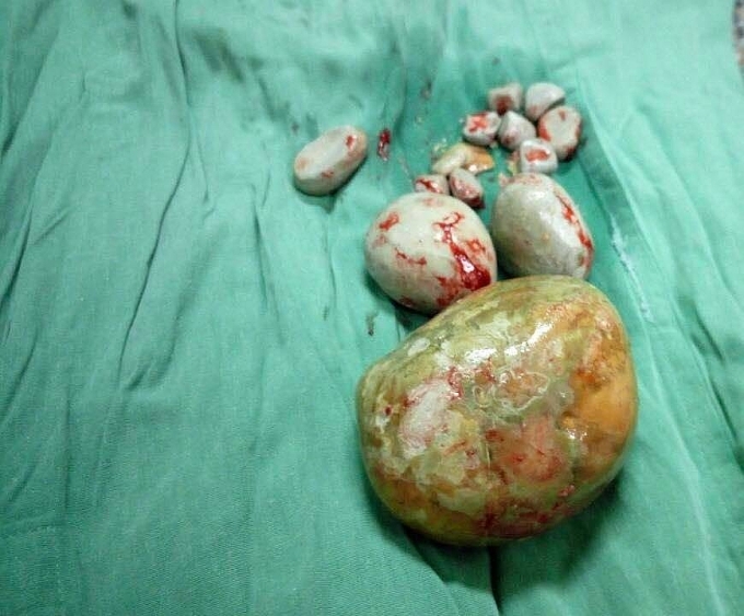 Phẫu thuật thành công lấy viên sỏi "khổng lồ" cho cụ bà 84 tuổi phau thuat thanh cong lay vien soi sieu to khong lo cho cu ba 84 tuoi