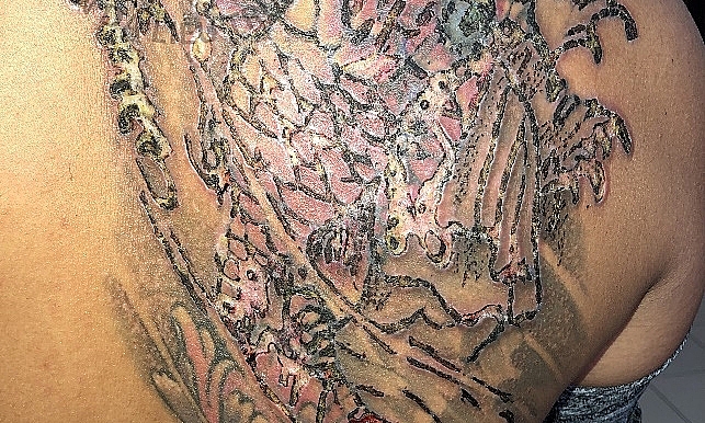 xam roi xoa thanh nien chang chit vet mu tren vai phai do bien chung