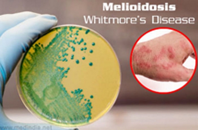 Vi khuẩn "ăn thịt người" đã từng gieo rắc nỗi ám ảnh trên thế giới như thế nào? vi khuan an thit nguoi da tung gieo rac noi kinh hoang tren the gioi nhu the nao