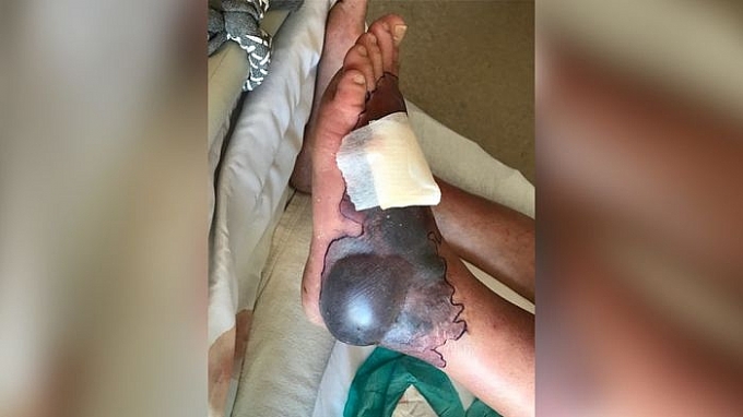 Vi khuẩn "ăn thịt người" đã từng gieo rắc nỗi ám ảnh trên thế giới như thế nào? vi khuan an thit nguoi da tung gieo rac noi kinh hoang tren the gioi nhu the nao