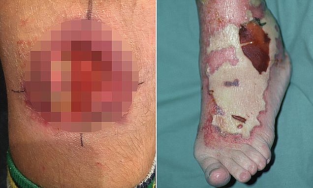 Vi khuẩn "ăn thịt người" đã từng gieo rắc nỗi ám ảnh trên thế giới như thế nào? vi khuan an thit nguoi da tung gieo rac noi kinh hoang tren the gioi nhu the nao