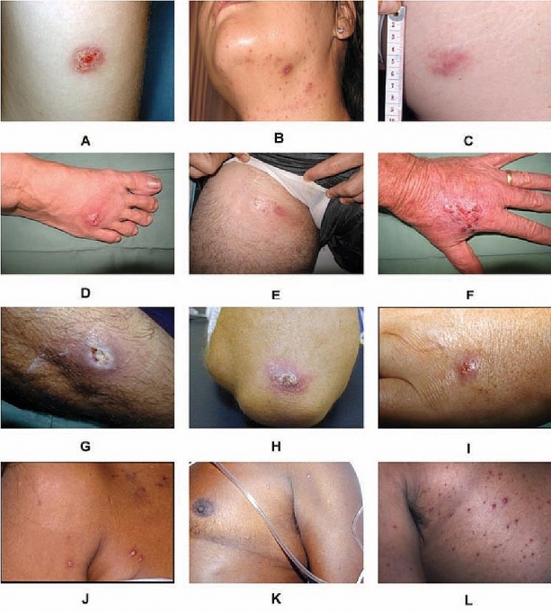 hieu dung ve vi khuan an thit nguoi mang ten whitmore