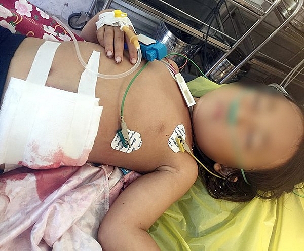 Bé gái 5 tuổi bị lưỡi máy cắt cỏ văng trúng bụng nguy kịch be gai 5 tuoi bi luoi may cat co vang trung bung nguy kich