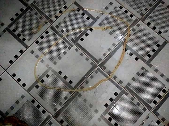 Kinh hãi sán xơ mít dài 2 mét nằm trong bụng người đàn ông vùng cao kinh hai san xo mit dai 2 met nam trong bung nguoi dan ong vung cao